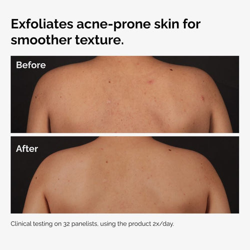 Before and After images showing a person's back. The 'Before' image displays body acne and uneven texture, while the 'After' image shows visibly smoother, clearer skin after using the product.